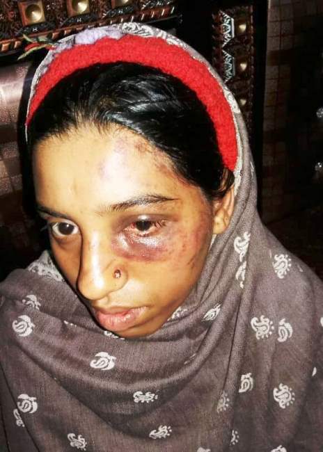 Pakistan: Woman tortured by inlaws for giving birth to second baby girl